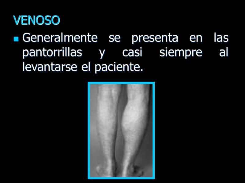 VENOSO Generalmente se presenta en las pantorrillas y casi siempre al levantarse el paciente.